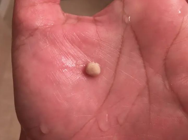 Sneezed 4-5 times yesterday and then started feeling something in my throat. Today the throat is clear after this thing came out. What is this?