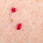 Close up photo of cherry angioma on human skin