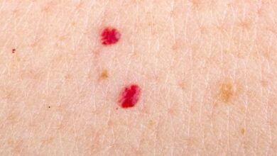 If you spot these red dots on your skin, here’s what they mean